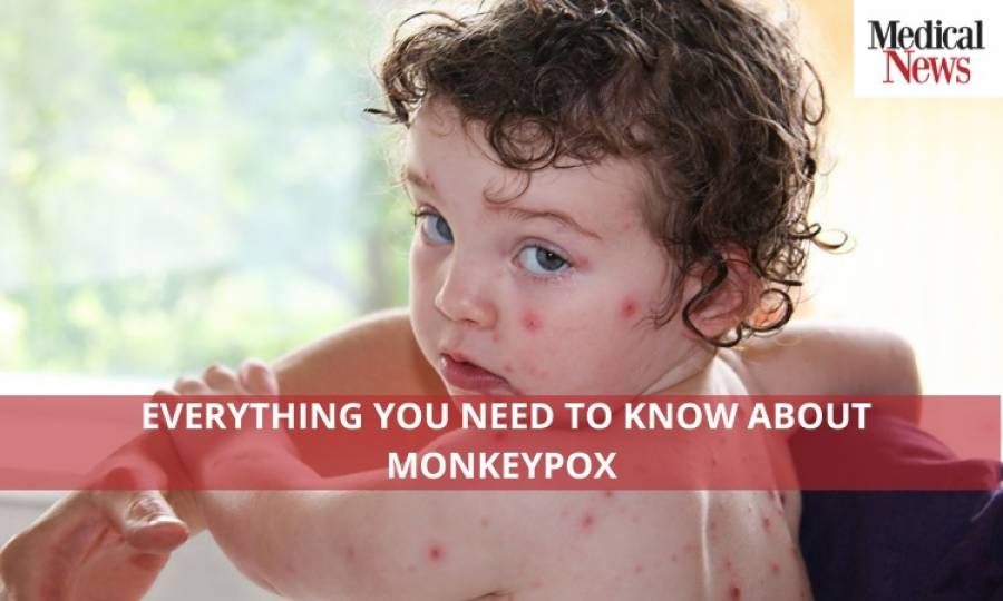 Everything You Need to Know About Monkeypox