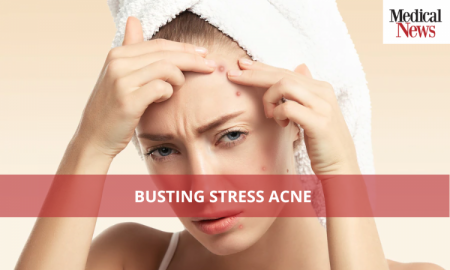 Busting Stress Acne