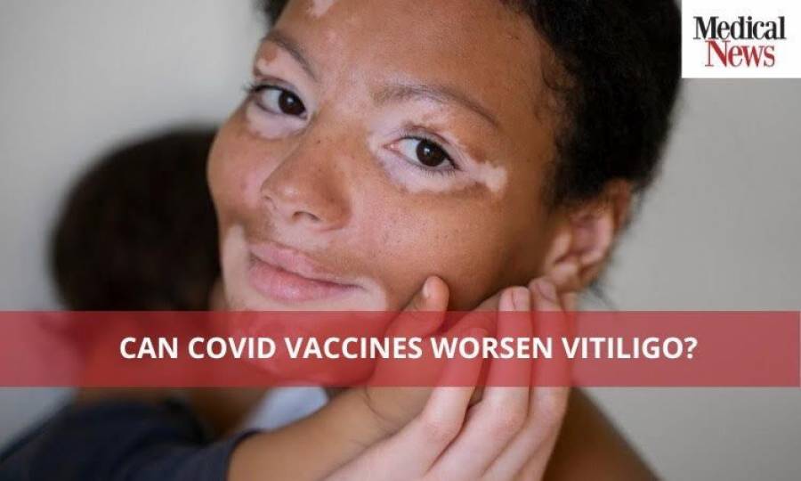 Can COVID Vaccines Worsen Vitiligo?