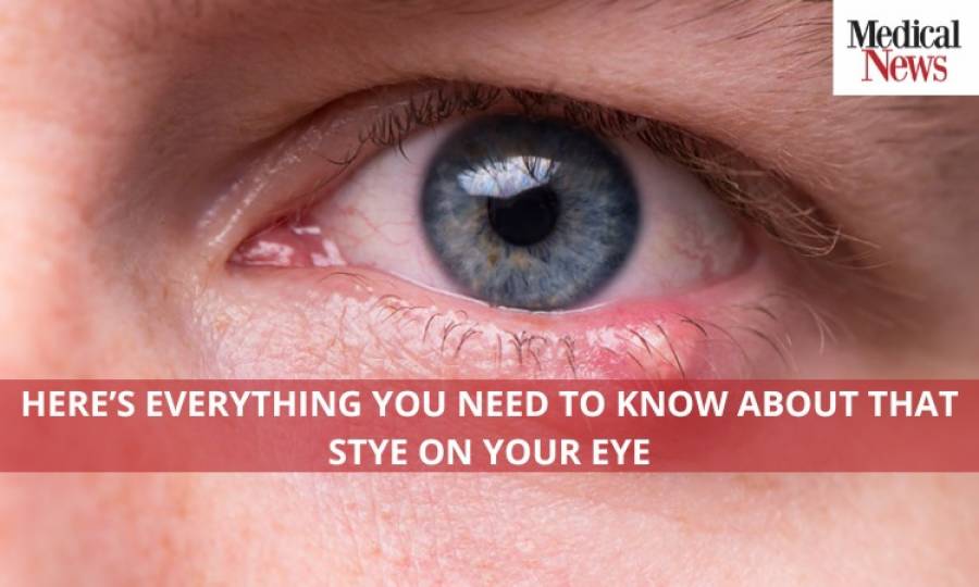 Here's Everything You Need to Know About That Stye On Your Eye 