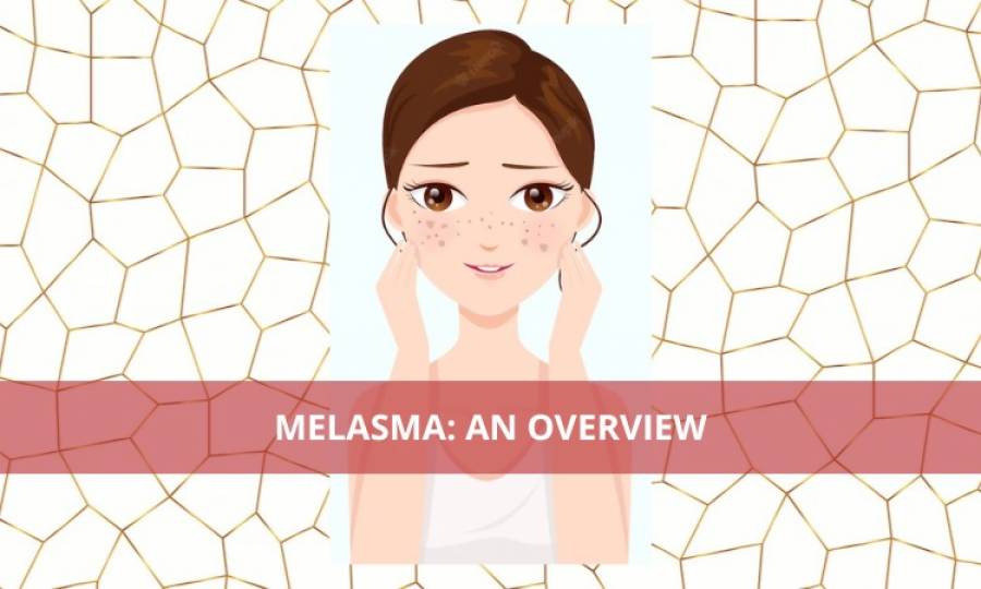     Melasma: An overview 