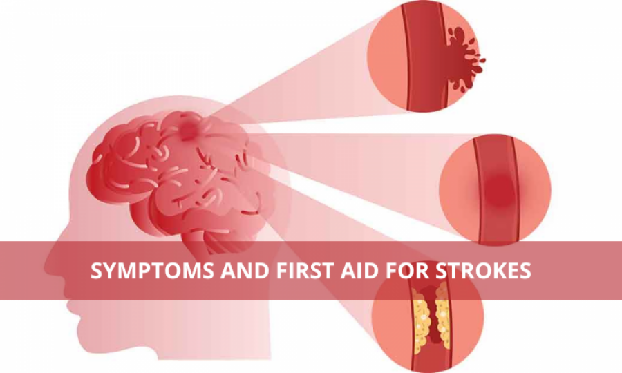 Symptoms and First Aid for Strokes