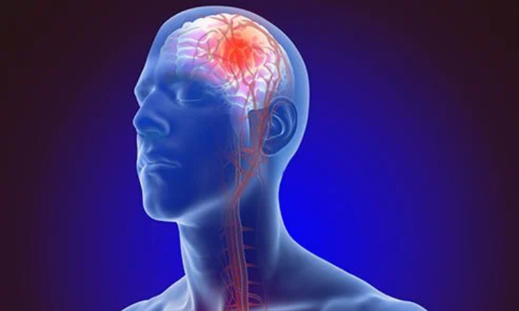 HKUMed research shows 30% increase in ‘young stroke’ incidence in Hong Kong