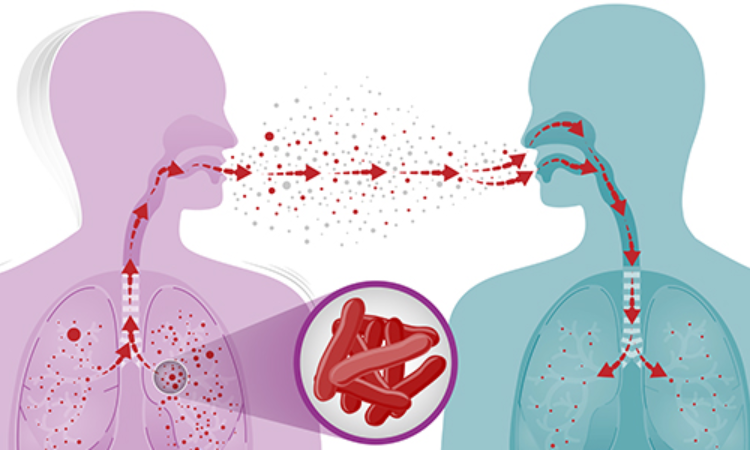 Tuberculosis deaths and disease increase during the COVID-19 pandemic