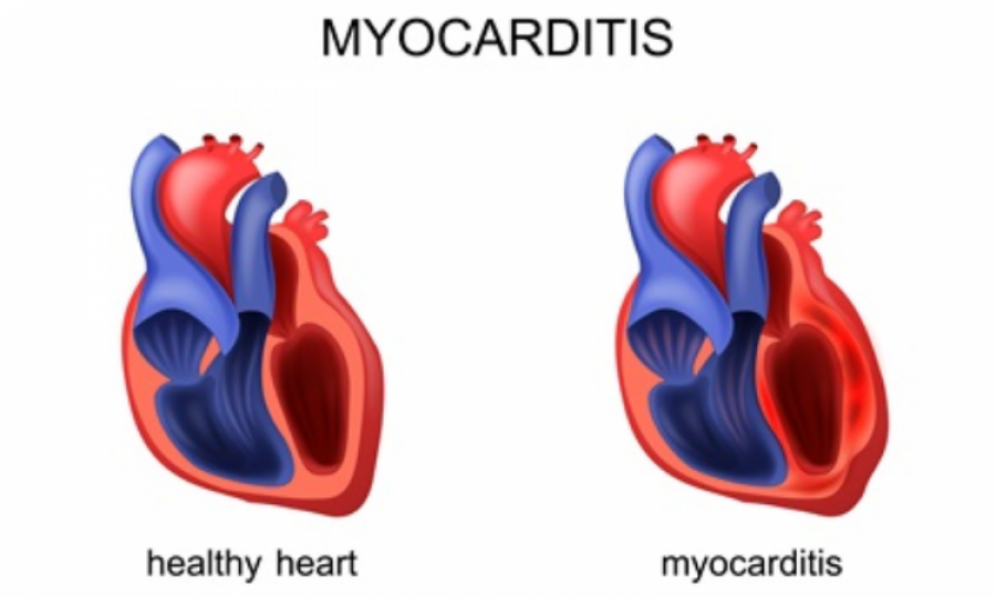 Myocarditis in cancer patients driven by specific immune cells 