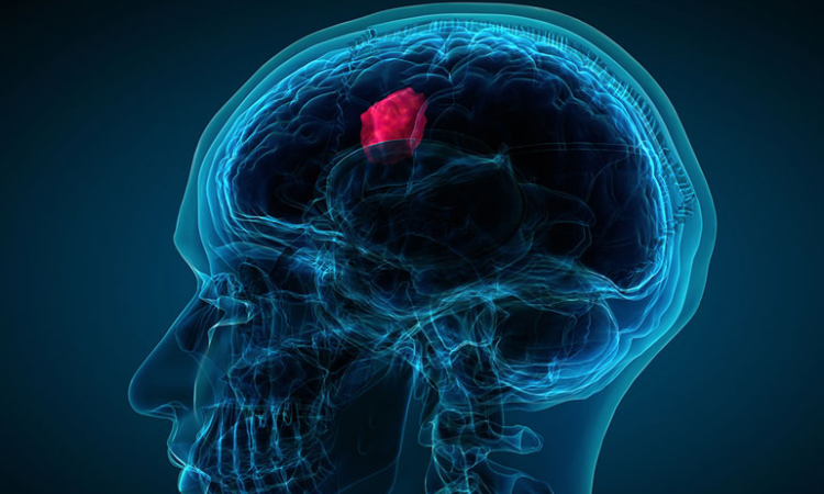 Predicting the post surgical effects on Speech Tumors