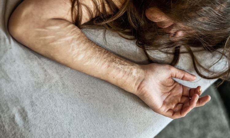 Prevalence of repeat self-harm rises rapidly in young children: Research