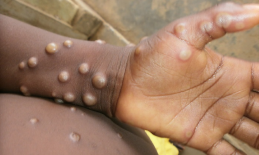 WHO recommends new name for monkeypox disease