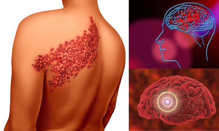 Shingles can contribute to an increased risk in heart disease: Study