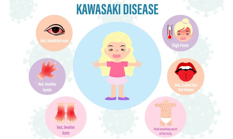 Study: New tool accurate at predicting antibody resistance among children with Kawasaki disease