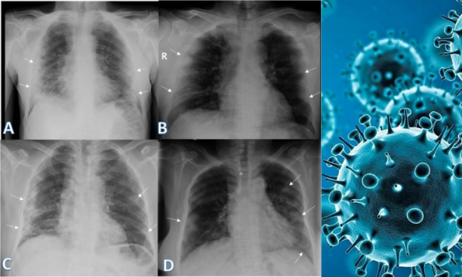 New X-ray technology can improve Covid-19 diagnosis