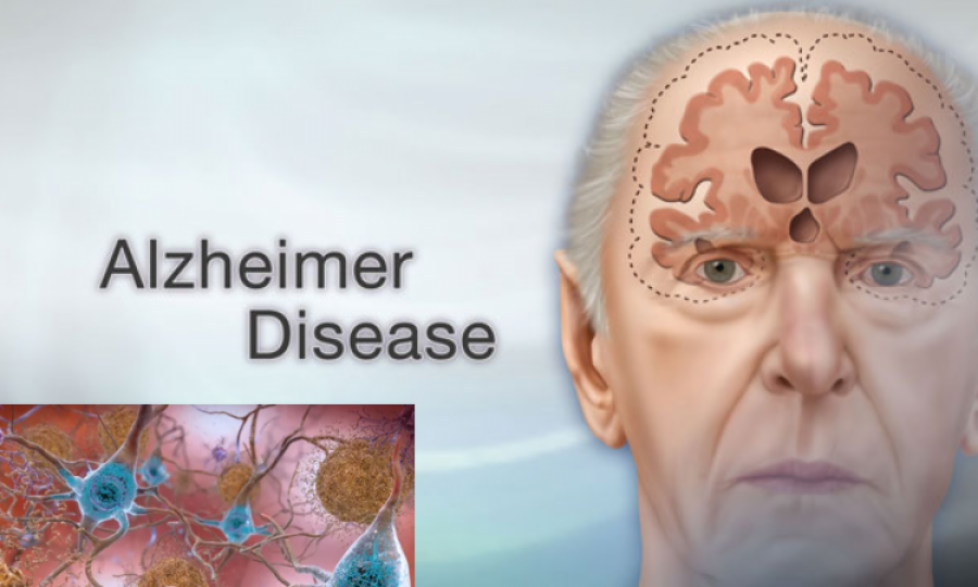 Researchers express mixed feelings over new Alzheimer’s drug