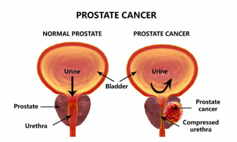 The increasing incidence of prostate cancer