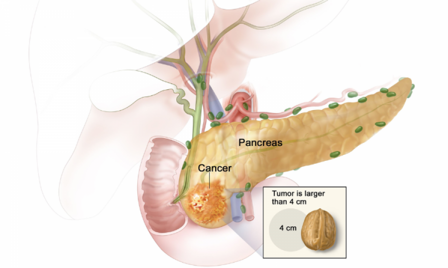 Can pancreatic cancer metastasize to spermatic cord and testes? BMJ