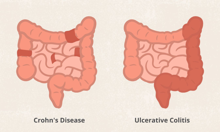 Lifestyle changes can prevent IBS: BMJ