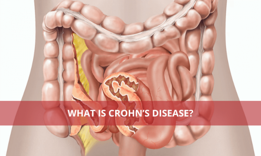 What is Crohn’s disease?