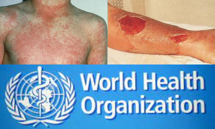 Increased incidence of scarlet fever and invasive Group A Streptococcus infection