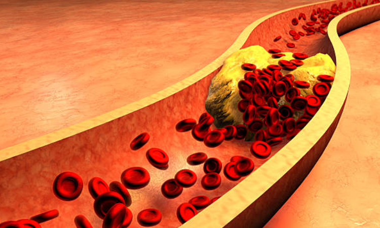 Cholesterol and Hypertension can increase risk of CVDs: Study