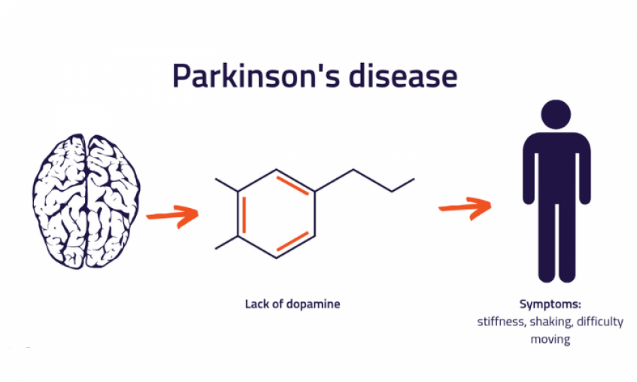 Parkinson's becomes 50% more prevalent than reported previously