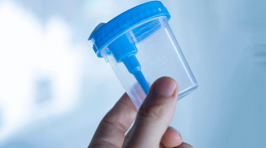 Urine test for prostate cancer using AI and gene analysis for early detection in men