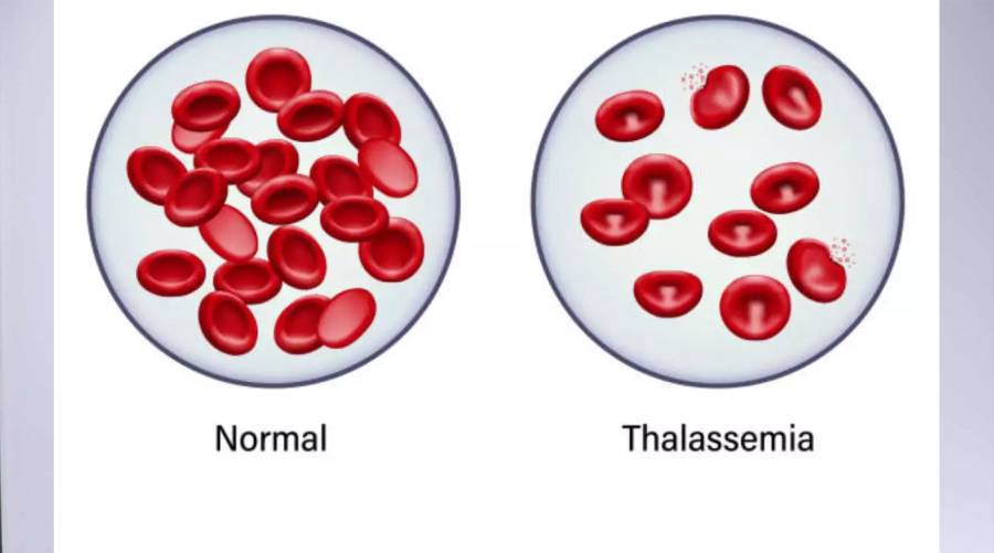 Pakistani girl Ayeza treated for thalassemia using CS-101 gene-editing therapy in China