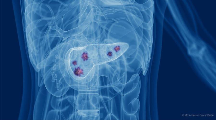 Microscopic image of pancreatic cancer cells spreading to the liver and lungs due to PCSK9 protein activity
