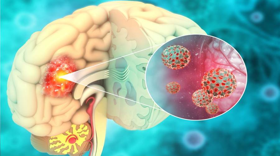 MRI brain scan being reviewed by a doctor for potential brain tumor diagnosis