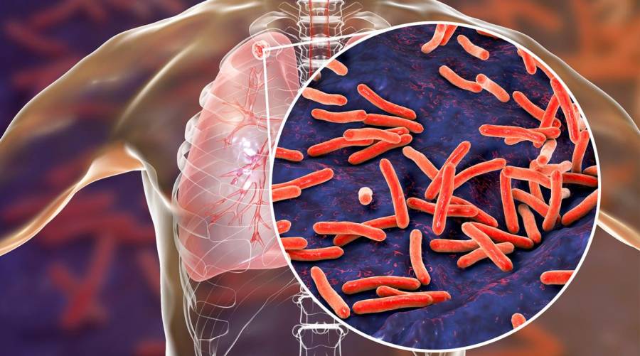 Global TB progress faces challenges due to funding gaps, warns WHO.