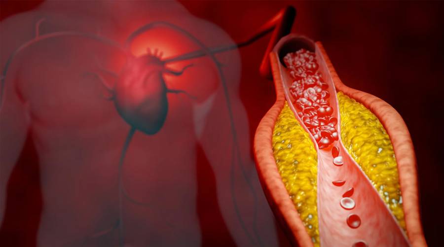 New oral drug to reduce LDL cholesterol shows major breakthrough in cardiovascular care