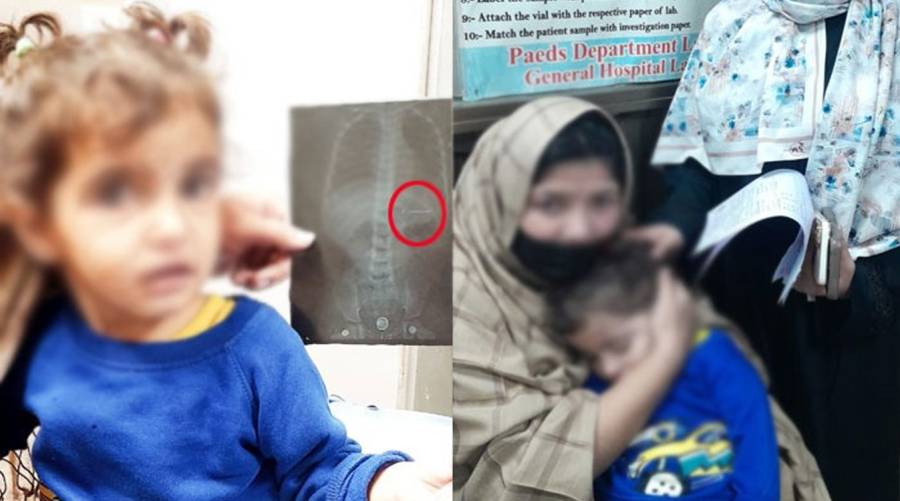 Doctors at Lahore General Hospital successfully removed a hairpin from a three-year-old girl’s stomach, and the child is now stable.
