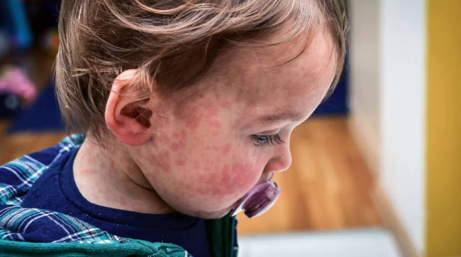 Rising measles cases in the United States spark concerns for public health and vaccination campaigns.
