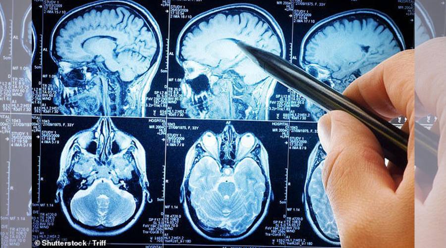 Early brain changes linked to dementia affecting spatial awareness before memory loss