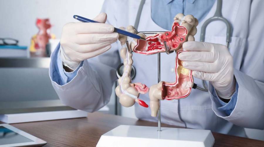 Medical illustration showing colon cancer and warning signs in young adults.
